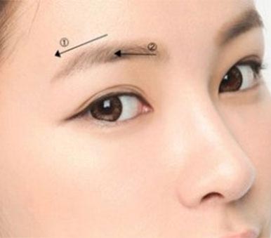 Nâng cung mày, treo mí sụp